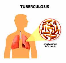 आठ महिनामा ९ सय ९२ क्षयरोगी, २८ जनाको मृत्यु